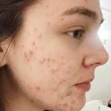 Anti acne Study P.Acne
