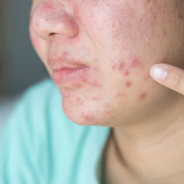 Skin Irritation (Reconstructed Epidermis)
